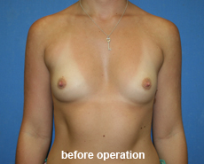 plastic-surgery-breast-augmentation